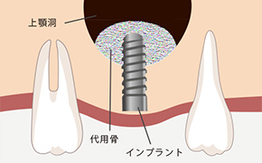 ソケットリフト